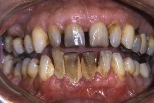 Gyönyörű dohányos fogak...