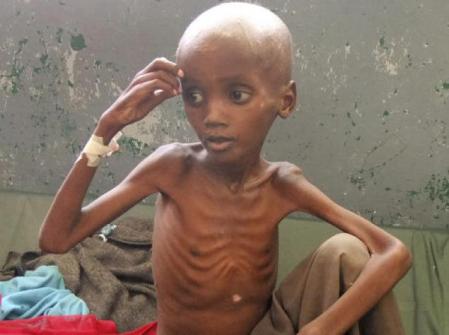 Alultáplált szomáliai kisgyermek